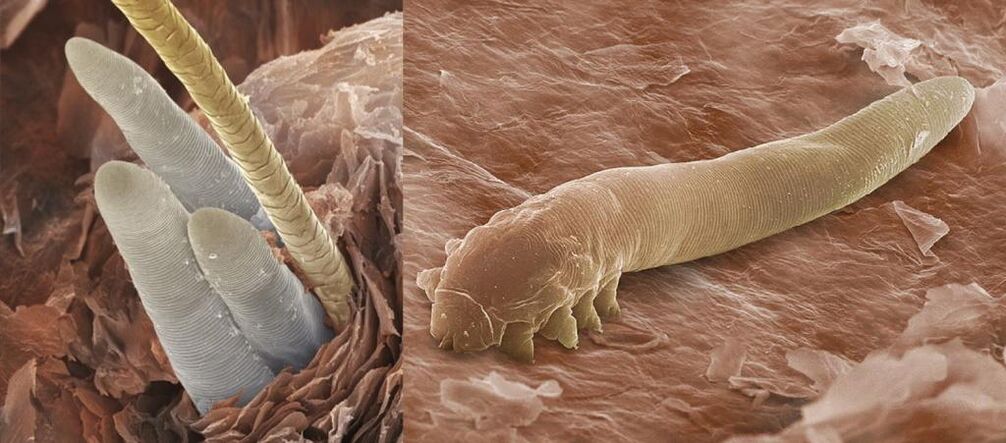 Ectoparitis