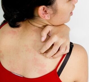 granulomas in the body - signs of the presence of parasites