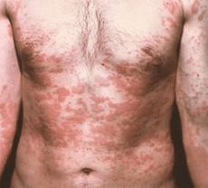 problematic skin is a sign of the presence of parasites