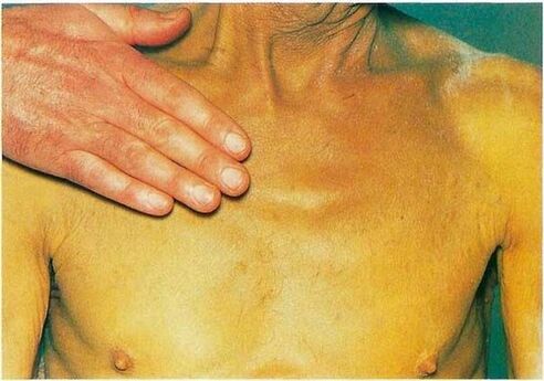 Jaundice due to parasites in the body