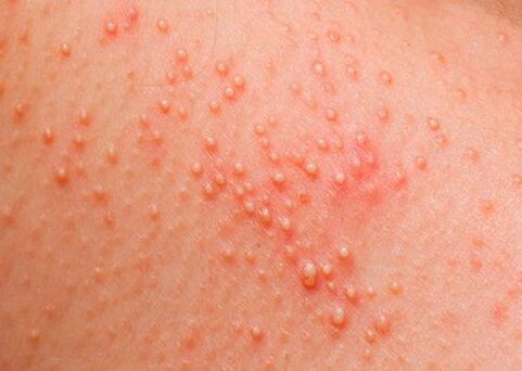 If the body is affected by parasites, skin allergies appear