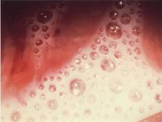 bubble discharge with protozoa parasites