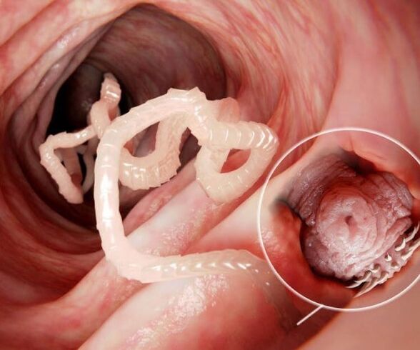 worms in the human intestine Figure 2